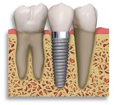 implant tooth2